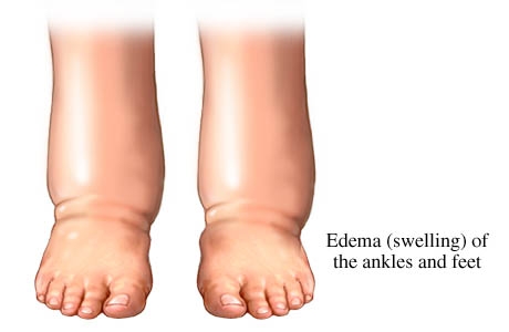 Swollen ankles, feet and legs (oedema) - NHS